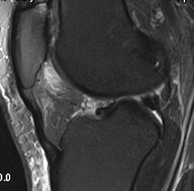 Fat Pad Impingement MRI